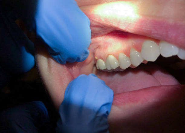 Best Emergency Treatment for Toothache in Lawson, MO
